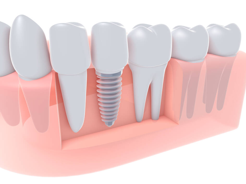 bone grafting perth