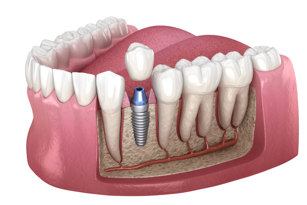 Single and Multiple Dental Implants Australia